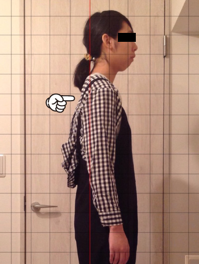 美骨整復術による改善例