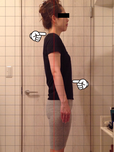 美骨整復術による改善例