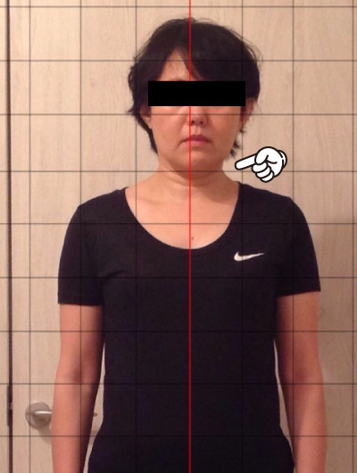 美骨整復術による改善例