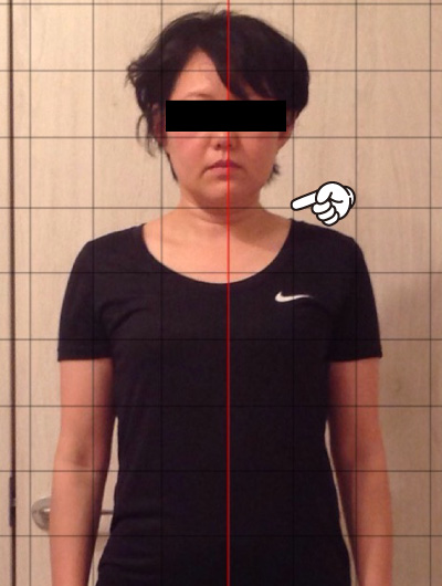 美骨整復術による改善例