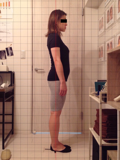 美骨整復術による改善例