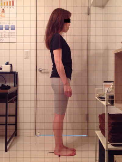 美骨整復術による改善例